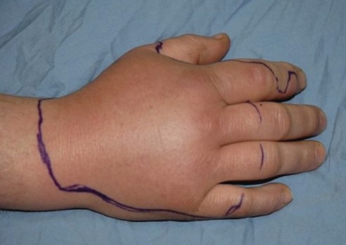 swollen hand